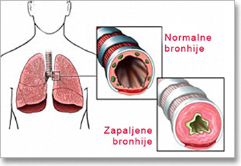 bronhijalna-astma